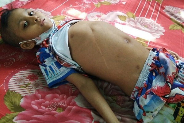 Liên tục ói ra máu, bé trai 8 tuổi bị xơ gan xin cứu gấp Liên tục ói ra máu, bé trai 8 tuổi bị xơ gan xin cứu gấp