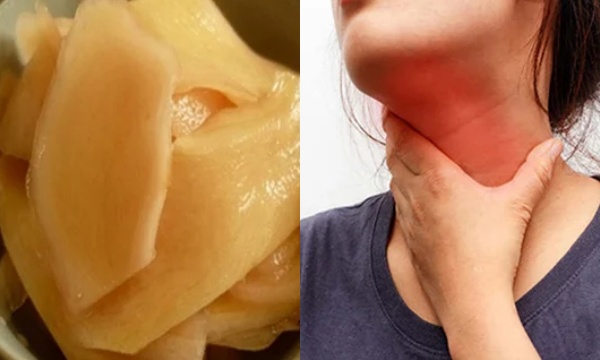 Món ăn chữa dứt chứng trào ngược dạ dày, ngăn ngừa K thực quản Món ăn chữa dứt chứng trào ngược dạ dày, ngăn ngừa K thực quản