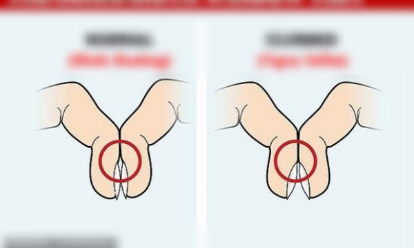 Áp 2 đầu ngón tay vào nhau để biết mình có nguy cơ mắc K phổi không? Áp 2 đầu ngón tay vào nhau để biết mình có nguy cơ mắc K phổi không?