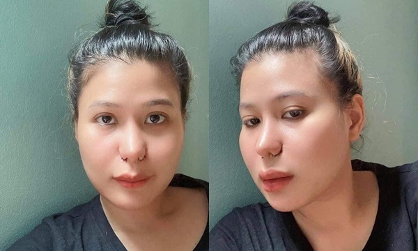 Pha thẩm mỹ mũi đi vào lòng đất Pha thẩm mỹ mũi đi vào lòng đất