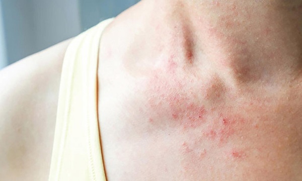 Da bị ngứa mùa này chưa chắc đã là do dị ứng, nếu bị ngứa ở 3 chỗ thì có thể là dấu hiệu nhiễm virus HPV Da bị ngứa mùa này chưa chắc đã là do dị ứng, nếu bị ngứa ở 3 chỗ thì có thể là dấu hiệu nhiễm virus HPV